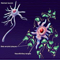 Trị bệnh Alzheimer bằng hạt vàng nano
