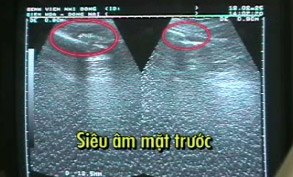Lần đầu tiên Việt Nam nắn xương bằng siêu âm