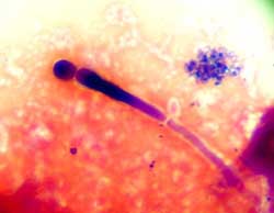 Viêm nhiễm âm đạo do nấm candida