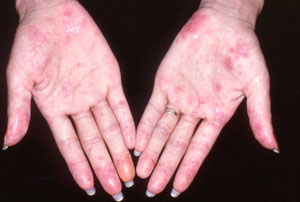 Trị bệnh lupus bằng tế bào gốc