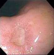 9 câu hỏi thường gặp về bệnh loét dạ dày