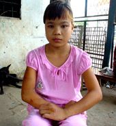 Vết bầm trên da