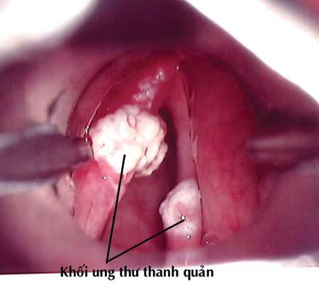 Phát minh test chẩn đoán 12 loại bệnh ung thư
