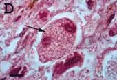 Nhiễm nấm Panicillium marneffei: Một chỉ điểm AIDS