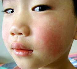Mỹ: Bùng phát lây nhiễm bệnh quai bị
