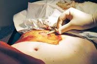Hiệu quả điều trị chống tái nghiện Heroin bằng Abernil