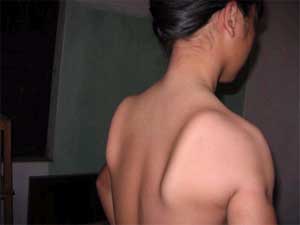 Bộ Y tế ban hành phác đồ điều trị teo cơ Delta