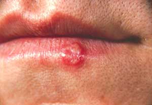 Các tổn thương mô miệng ở trẻ em