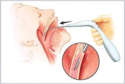 Kỹ thuật mới điều trị ngưng thở khi ngủ do ngáy