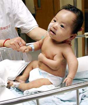 Tách bỏ thành công cánh tay thứ ba của bé 2 tháng tuổi
