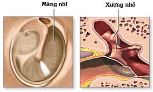 Biểu hiện của thủng màng nhĩ