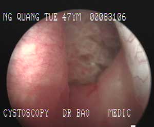 Vỡ bàng quang
