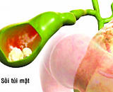 Chế độ ăn cho người bị sỏi mật