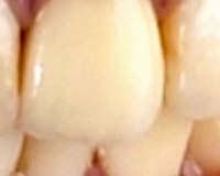 Công nghệ mới giúp răng gãy có thể mọc lại