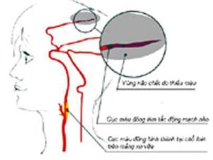 Hẹp động mạch cảnh - một trong những nguyên nhân gây tai biến mạch máu não