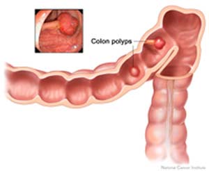 Quá ít lượng folate có thể dẫn đến ung thư ruột kết.