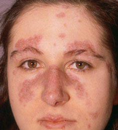 Phụ nữ mắc bệnh lupus không nên mang thai