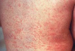 Xuất hiện triệu chứng rubella ở Hóc Môn