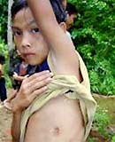 Bị sán lá phổi vì ăn cua