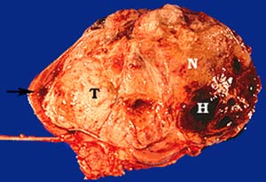Phát hiện gien gây ung thư thận ở trẻ em