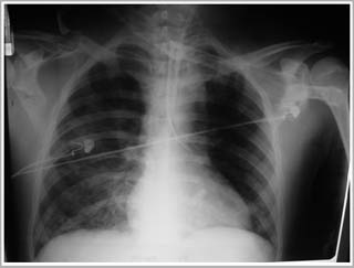 Xét nghiệm nước tiểu giúp dự đoán tổn thương phổi
