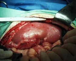 Ghép nội tạng lợn cho... người