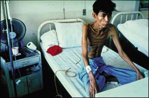 Phát hiện sớm và điều trị lao cho người nhiễm HIV
