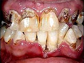 Càng uống nhiều nước ngọt, càng dễ hư men răng