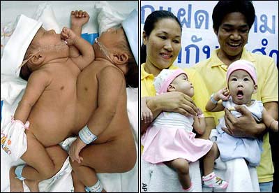 Thái Lan: Tách rời thành công cặp song sinh dính liền tim