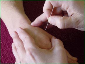 Châm cứu và xoa bóp giúp làm dịu cơn đau sau phẫu thuật ung thư