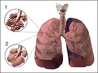 Phương pháp điều trị mới giúp ích cho người bị khí phế thủng