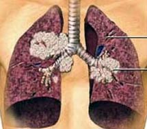 Nhu cầu thuốc chống ung thư tăng cao tại châu Á