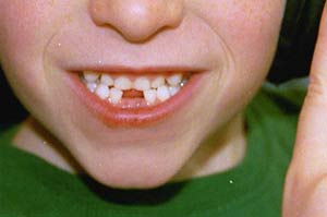 Trẻ em đang sâu răng nhiều hơn