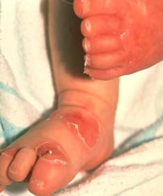 Bỏng da - Những điều cần biết