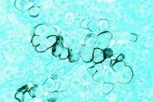 Công nghệ nano đưa thuốc diệt tế bào ung thư