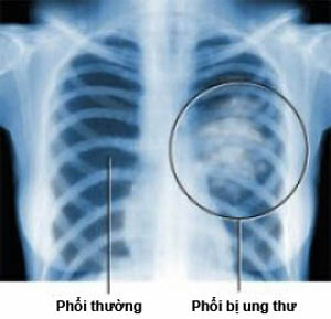 Xạ trị dự phòng ở não: Trị ung thư phổi tốt hơn