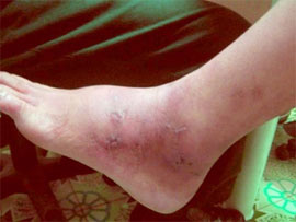 Giãn tĩnh mạch chân: Bệnh thường gặp ở phụ nữ lớn tuổi