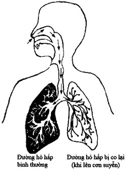 Phát hiện gien liên quan đến bệnh suyễn ở trẻ em