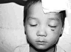 Cả ổ sán ký sinh trong mắt người hơn 1 năm