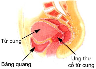Giấm: Thuốc thử ung thư cổ tử cung