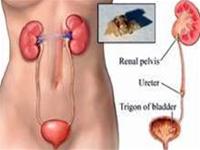 Sỏi niệu và những biến chứng nguy hiểm