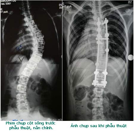 Khám chữa vẹo cột sống miễn phí cho bệnh nhân nghèo