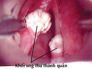 Amiante: Thủ phạm gây ung thư