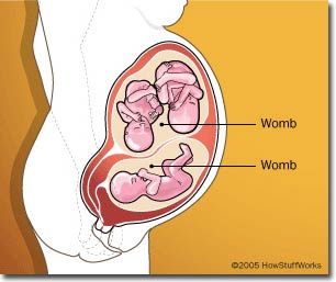 Người có hai tử cung hiếm khi sinh đôi