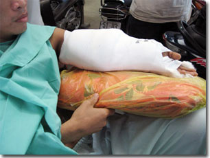 Điều trị gãy xương bằng tế bào gốc
