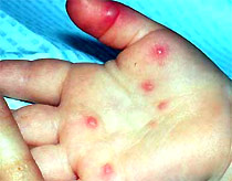 Châu Á quan ngại sự bùng phát bệnh chân tay miệng