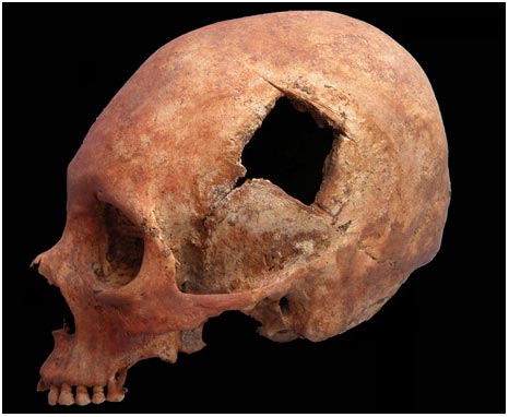 Phẫu thuật não của người Inca thuộc dạng <i>“trình độ cao”</i>