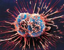 Bắt khối u 'nhịn ăn' để diệt ung thư 