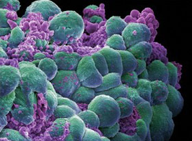 Xác định gene khiến tế bào ung thư vú di căn