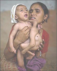 Nepal xôn xao vì em bé có 8 chân tay